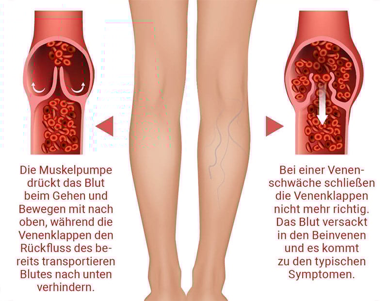 Schaubild Venendurchblutung in Aktion